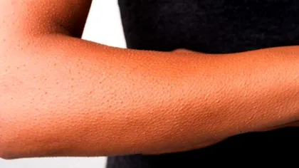 Adevărul despre 'pielea de găină'. Ce beneficii secrete are asupra sănătății oamenilor