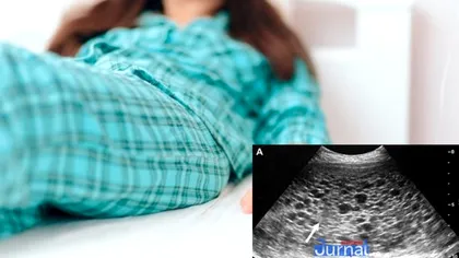 Ce este sarcina molară, cazul extrem de rar depistat la o fetiță de 12 ani din Iași. Ce înseamnă, de fapt