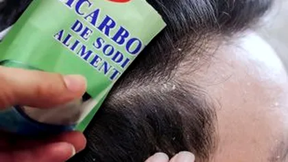 Cum scapi de mătreață cu bicarbonat de sodiu. Trucul secret care te salvează de probleme