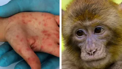 Cum se transmite variola maimuței, boala care sperie Europa. Primul simptom care apare în urma infecției