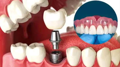 Diferențele dintre implanturi dentare, proteză și punte. Avantaje și diferențe dacă mergi la dentist