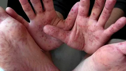 O nouă boală provoacă îngrijorări, după variola maimuței. Ce este gripa tomatelor și cum se manifestă