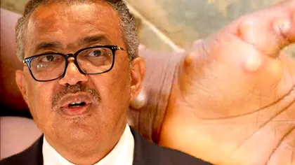 OMS, decizie neașteptată privind variola maimuței. Motivul pentru care vrea să-i schimbe denumirea