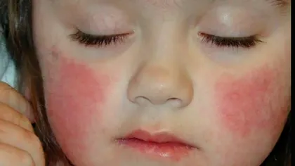 OMS, semnal de alarmă cu privire la infecția care face ravagii în rândul copiilor sub 10 ani. La ce trebuie să fie atenți toți părinții