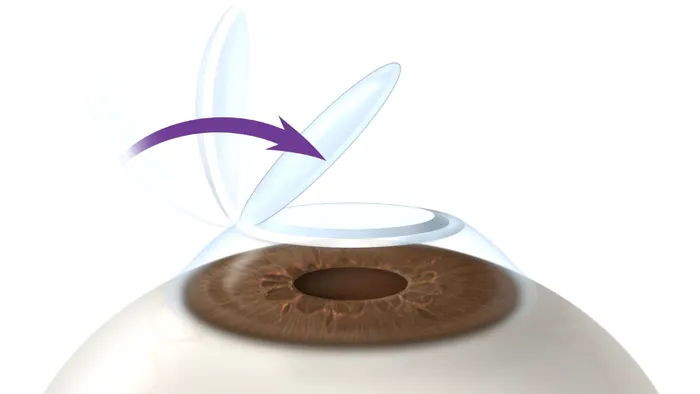 LASIK-Flap