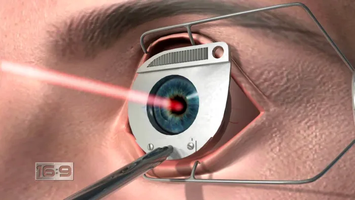 lasik