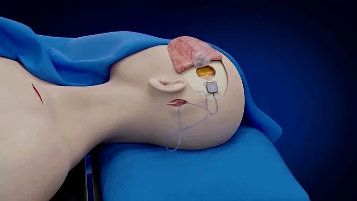 Sistemul este conceput pentru a fi complet implantat sub piele, fără cabluri externe.