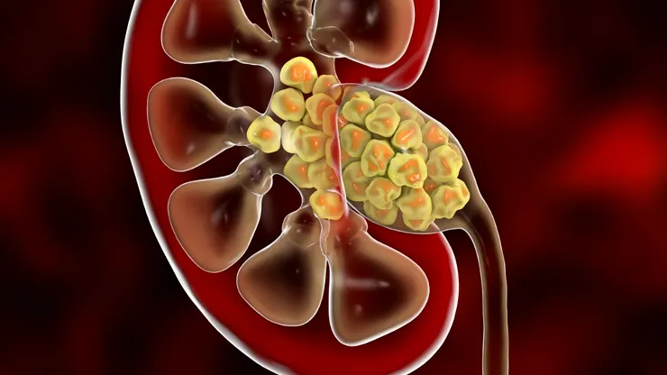 Descoperirea medicală care ar putea schimba totul: bacterii găsite în calculii renali modifică teoria formării pietrelor la rinichi